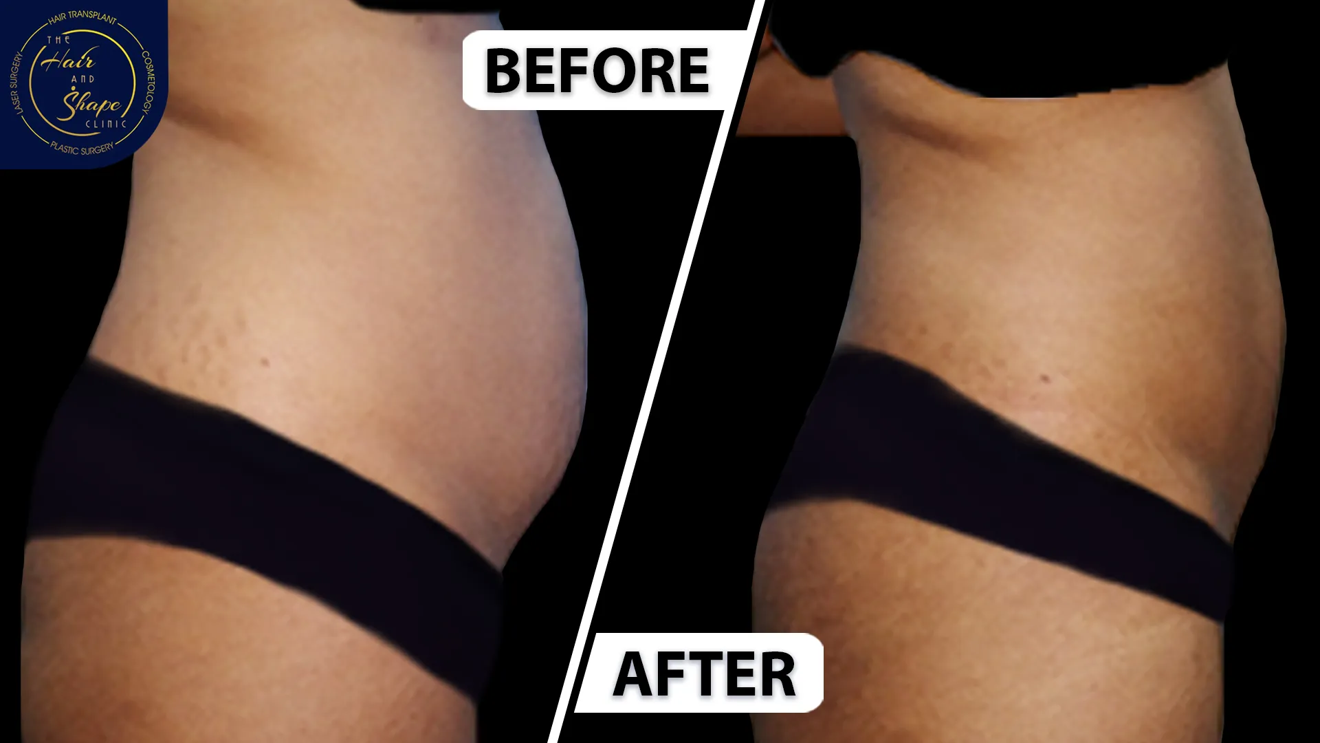 Liposuction result2